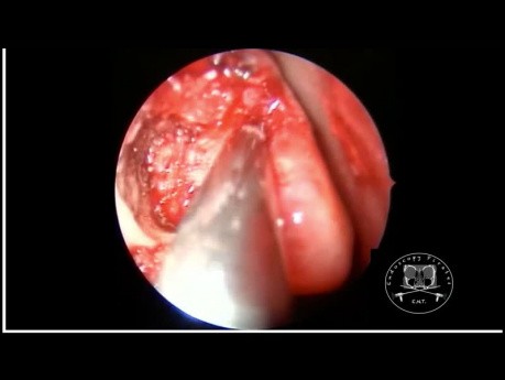 Endoscopic DCR