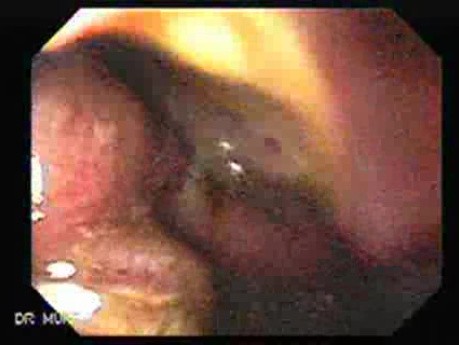 Presence of Multiple Irregular and Large Ulcers - Suspicion of Lymphoma