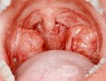Normal Enlarged Tonsils