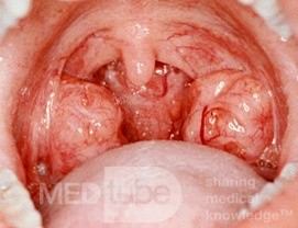 Normal Enlarged Tonsils