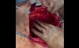 Peritoneal Flap Hernioplasty