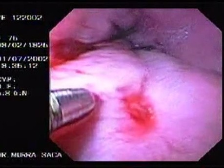 Hemorrhage due status post rubber band ligation of esophageal varices (14 of 25)
