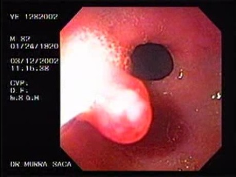 Hyperplastic Gastric Polyp (2 of 3)