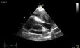 Transesophageal Echocardiography,  Right Ventricular Outflow Tract (RVOT) - Presence of Mediastinal Mass