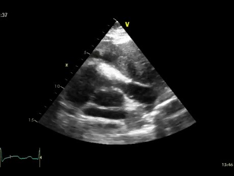 Transesophageal Echocardiography,  Right Ventricular Outflow Tract (RVOT) - Presence of Mediastinal Mass