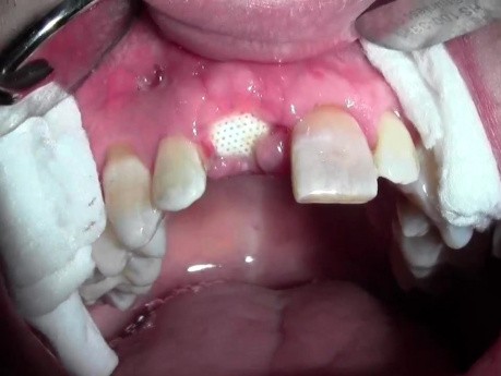 Extraction #8 With Socket Bone Grafting - D-Ptfe - Post-Op Healing - 2 Weeks Out