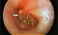 Acute Otitis Media - Early Stage