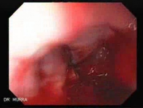 Severe Bleeding of the Upper Digestive System After Two Days of Band Ligation - Cause of Bleeding