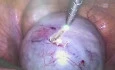 Laser in Endometriosis 