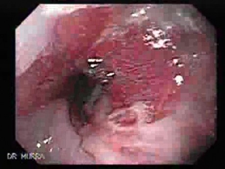 Hiatal Hernia - Above Is An Esophageal Stricture - 2/2