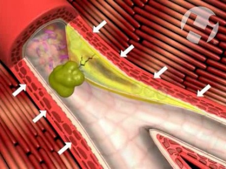 Unstable Plaques