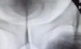 Baloon Dilatation of Complicated Urethral Structure