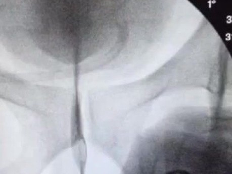 Baloon Dilatation of Complicated Urethral Structure