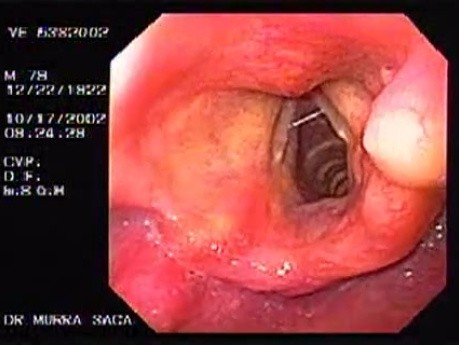 Oropharyngeal lipoma