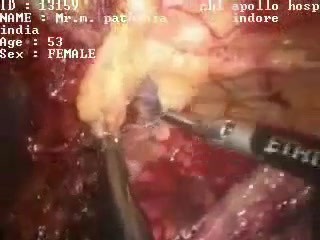 Adhesiolysis - laparoscopic surgery