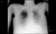 Coronavirus Chest X-Ray (1)