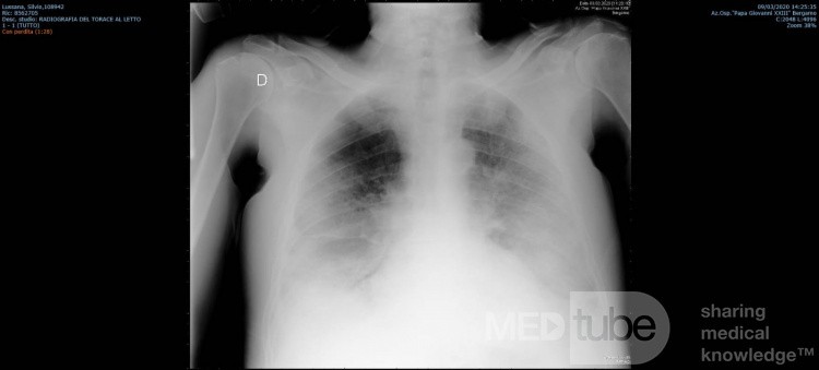 Coronavirus Chest X-Ray (1)