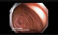 Colonoscopy Channel - Subtle Lesion Noted After Suction Of Fluid