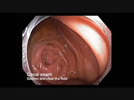 Colonoscopy Channel - Subtle Lesion Noted After Suction Of Fluid