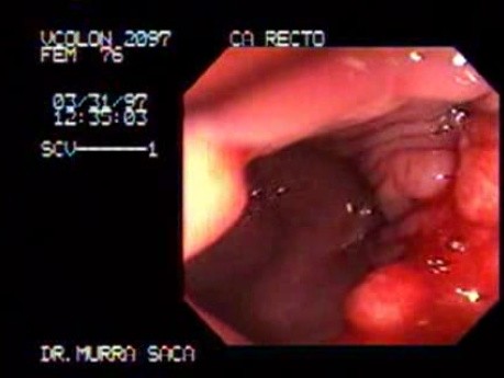 Endoscopy Of Rectal Adenocarcinoma (2 of 4)