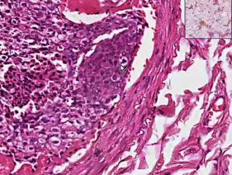 tumor emboli - Histopathology of lung