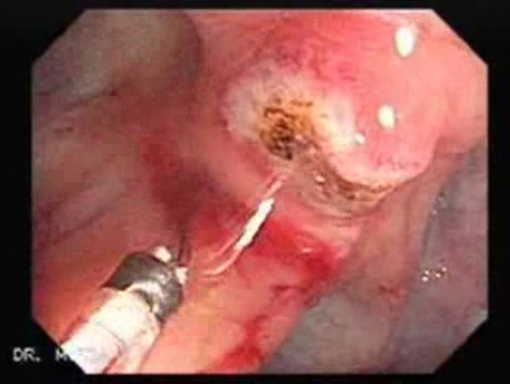 Colon Angiodysplasia (16 of 24)