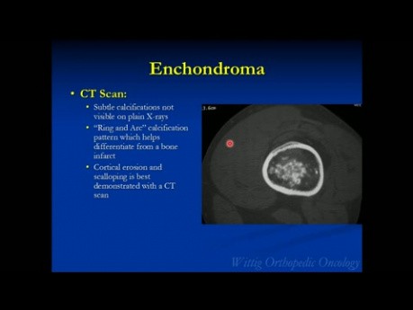 Orthopedic Oncology Course - Benign Cartilage Tumors (Osteochondroma, Chondroblastoma, etc.)- Lecture 5