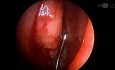 FESS Left Sinus Fungal Ball