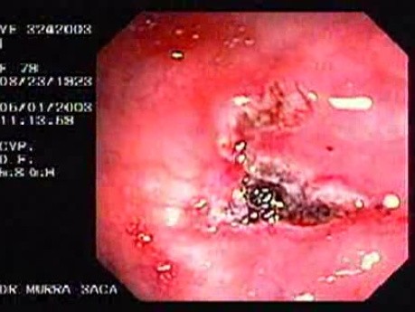 Dieulafoy´s Lesion (Exulceratio Simplex) (5 of 6)