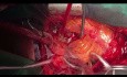 Patient with Pulmonary Stenosis and PS and PI undergone PVR