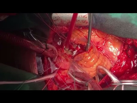 Patient with Pulmonary Stenosis and PS and PI undergone PVR
