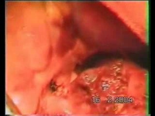 Lobectomy Due To A Tuberculous Cavern