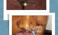 Residual defect due to gunshot wound with nasal retraction due to hypertrophic scar and microstomia