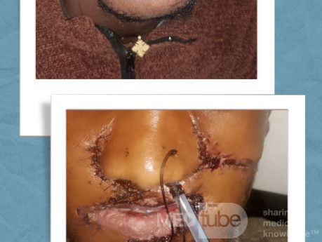 Residual defect due to gunshot wound with nasal retraction due to hypertrophic scar and microstomia