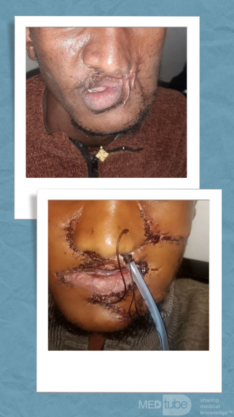 Residual defect due to gunshot wound with nasal retraction due to hypertrophic scar and microstomia
