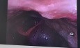Left Vallecular Cyst