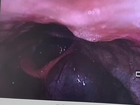 Left Vallecular Cyst