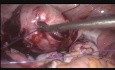 Myomectomy in Multiple Fibroids with Vicryl Suture