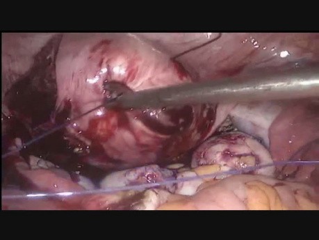 Myomectomy in Multiple Fibroids with Vicryl Suture
