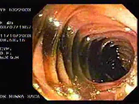 Enteroscopy (1 of 3)