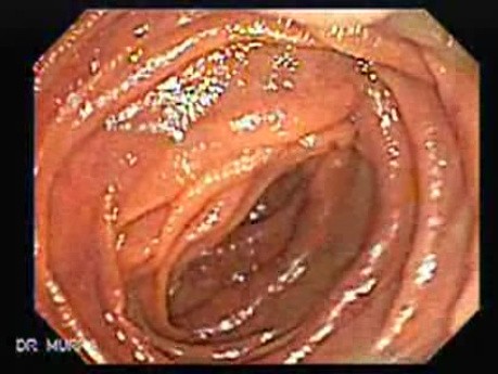 Jejunal Gastrointestinal Stromal tumor (GIST) (2 of 86)