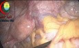 When You Do a Laparoscopy For Missed IUD Please Explore the Tube and Ovaries on Both Sides