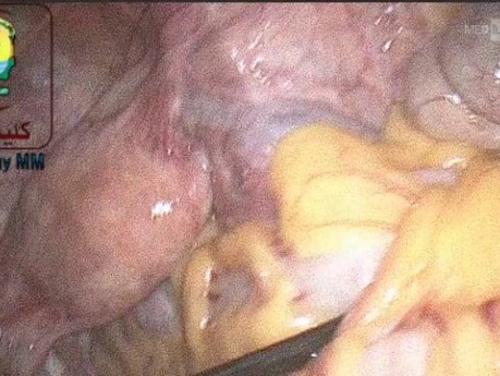 When You Do a Laparoscopy For Missed IUD Please Explore the Tube and Ovaries on Both Sides