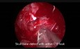 Endoscopic CSF Leak Repair CSF Rhinorrhea