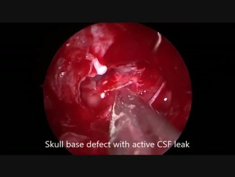 Endoscopic CSF Leak Repair CSF Rhinorrhea