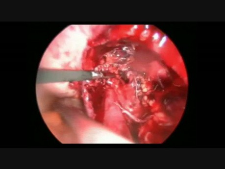 Laparoscopy for UreteralHydronephrosis Due to Endometriosis