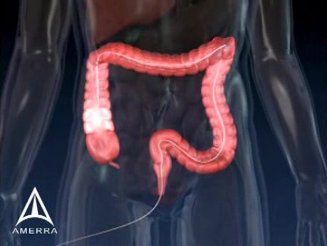 Colonoscopy - 3D Medical Animation