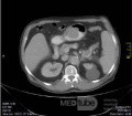 Gastrointestinal Stromal tumor (GIST) (10 of 13)