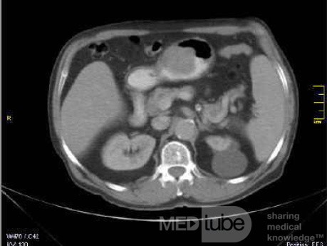 Gastrointestinal Stromal tumor (GIST) (10 of 13)
