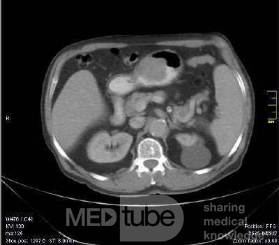 Gastrointestinal Stromal tumor (GIST) (10 of 13)